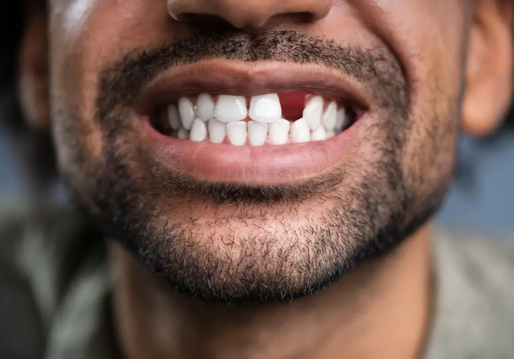 When to Get Missing Teeth Replaced?