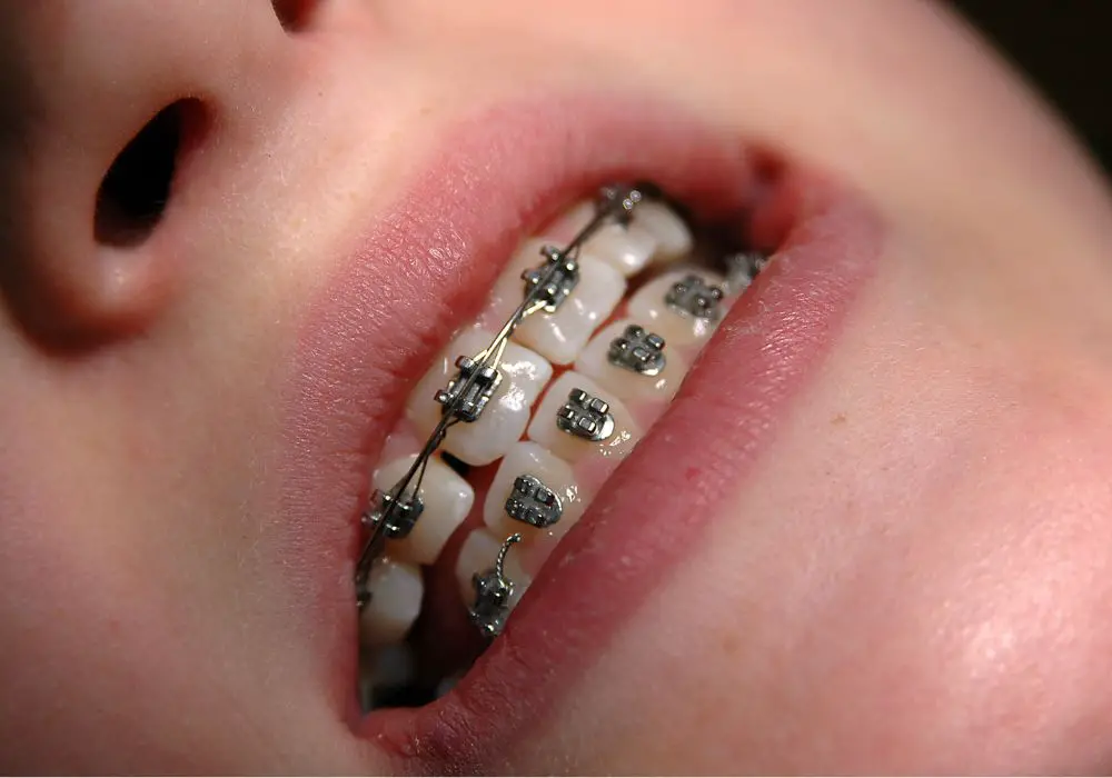 When to Notify Your Orthodontist About Pain