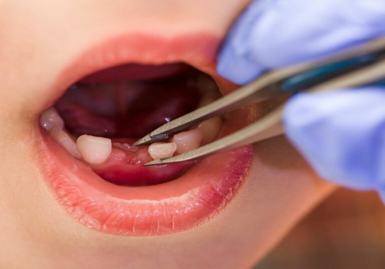 How To Remove Your Own Tooth How Can I Pull My Own Tooth Fast? (Ultimate Guide)