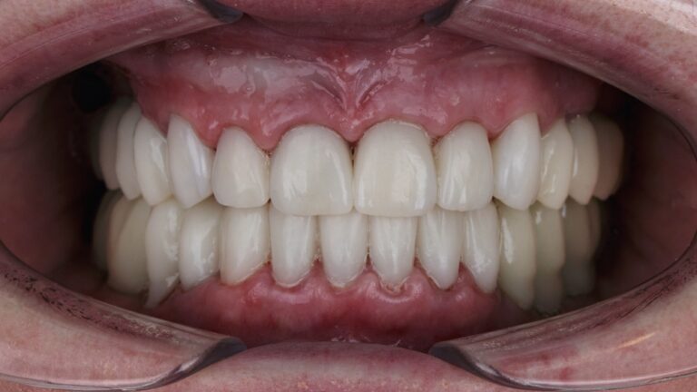 How to Whiten Bonded Teeth? (Ultimate Guide)