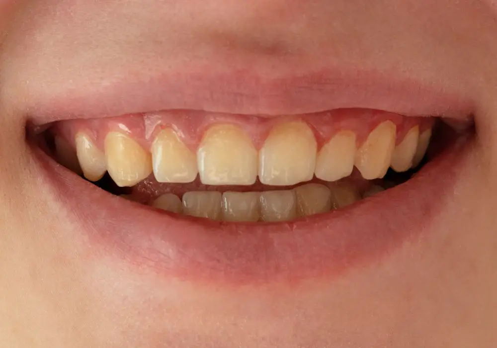 Whitening treatments for yellowed teeth