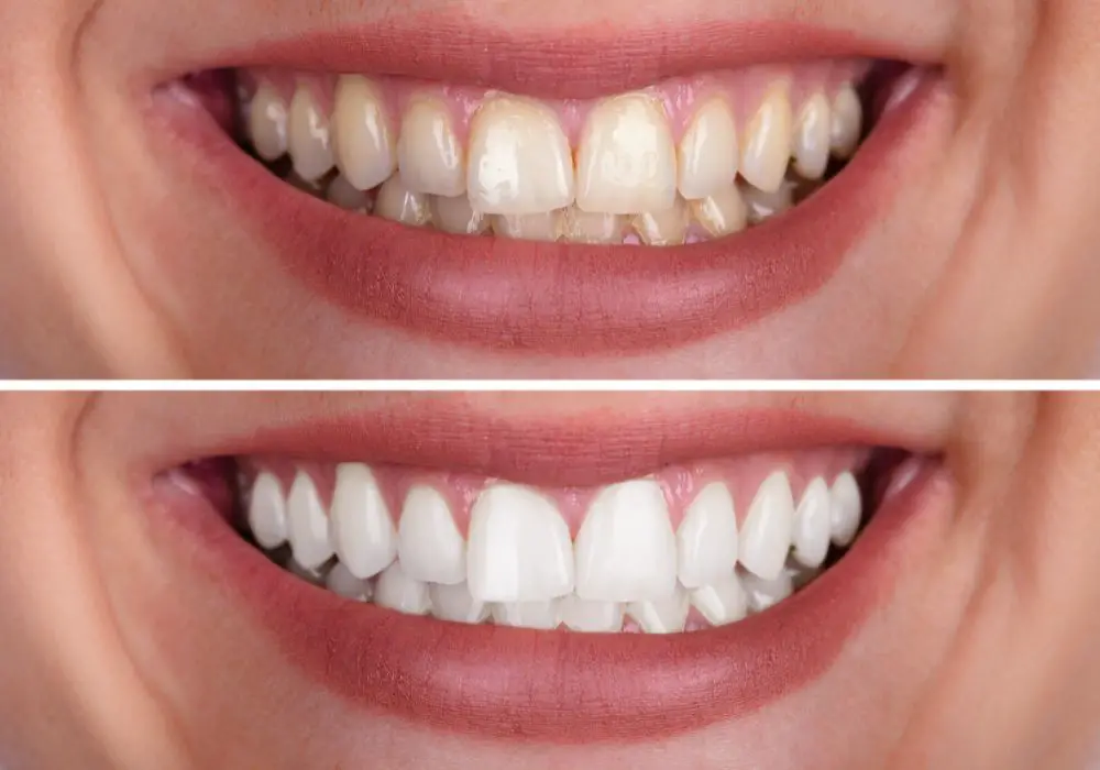 Who Typically Offers Teeth Whitening Training?