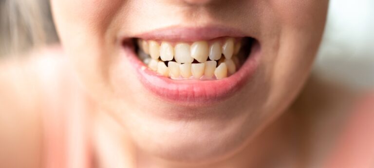 Why Are My Bottom Teeth Getting So Crooked? (Causes & Treatments)