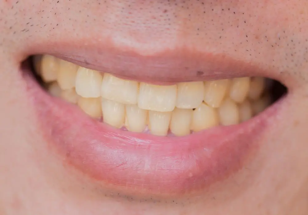Why Are My Teeth More Stain Prone Than Others?