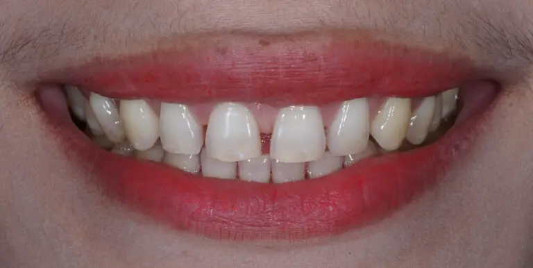 Why Are My Teeth Shifting As I Get Older? (Factors & Prevention)