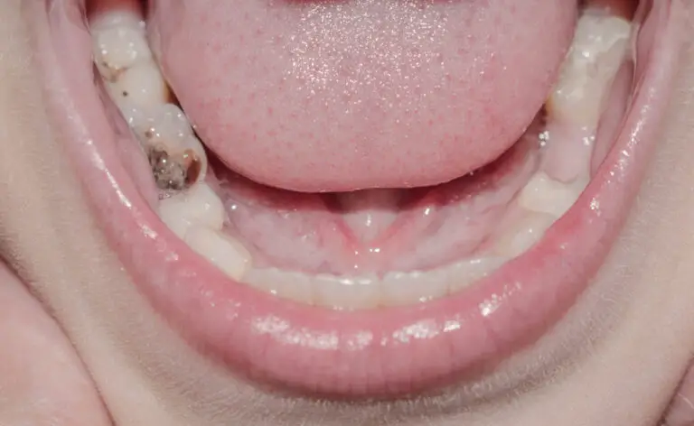 Why Are My Teeth Turning Black In Between? (Causes & Treatments)