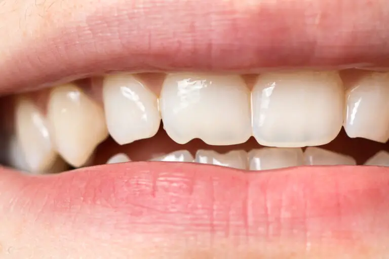 Why Are The Ends Of My Teeth Not Smooth? (Reasons & Treatments)