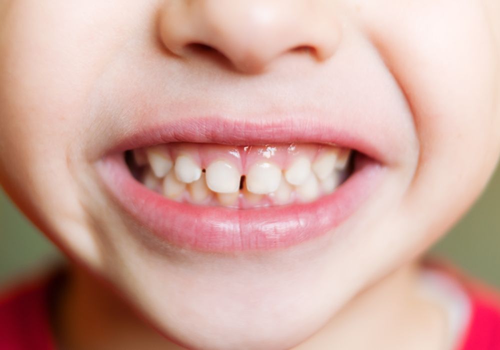 Why Baby Teeth Fall Out?