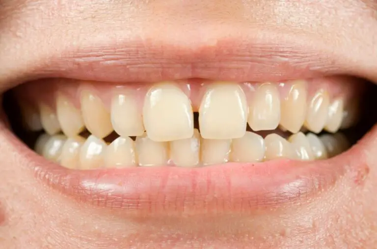 Why Do I Only Have 15 Bottom Teeth? Exploring the Reasons Behind This Uncommon Dental Condition