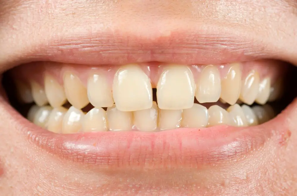 Why Do I Only Have 15 Bottom Teeth? Exploring the Reasons Behind This