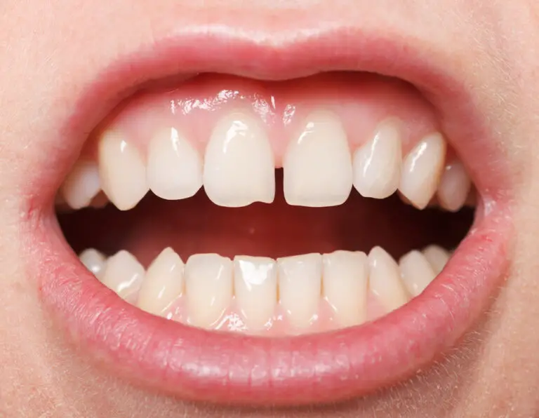 Why Do My Top Teeth Not Show When I Talk? (Causes & Treatments)