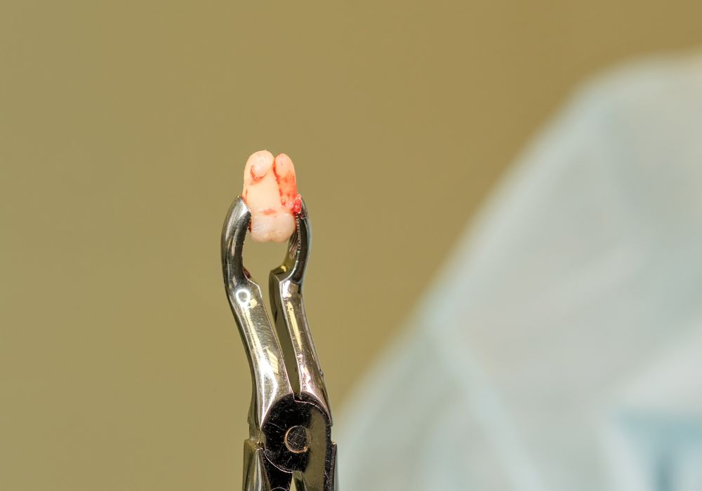 Why Do Patients Want Wisdom Teeth?