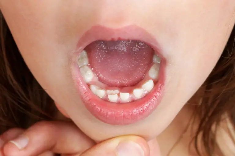 Why Do Some People Only Show Bottom Teeth? (Causes & Treatments)