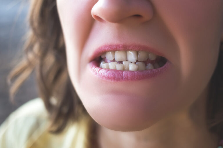Why Do Some Peoples Teeth Come In Crooked? (Causes & Treatments)