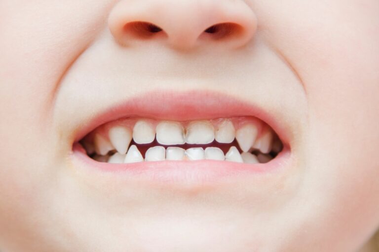 Why Does My Baby Have Black Stains on Teeth? (Causes and Solutions)