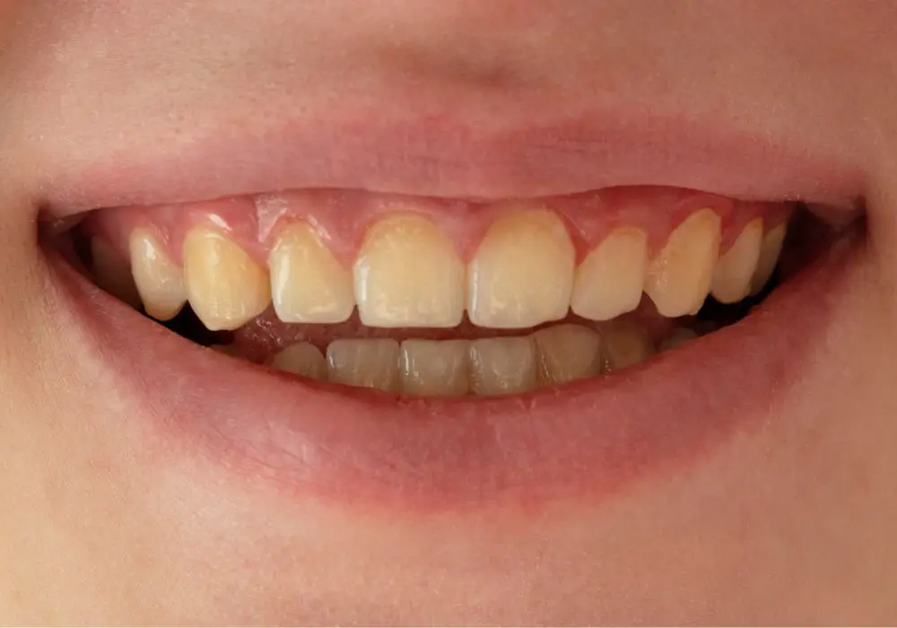 Why Teeth Turn Yellow with Age?