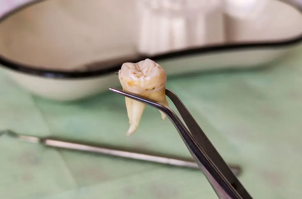 Why Wisdom Teeth Were Previously Removed