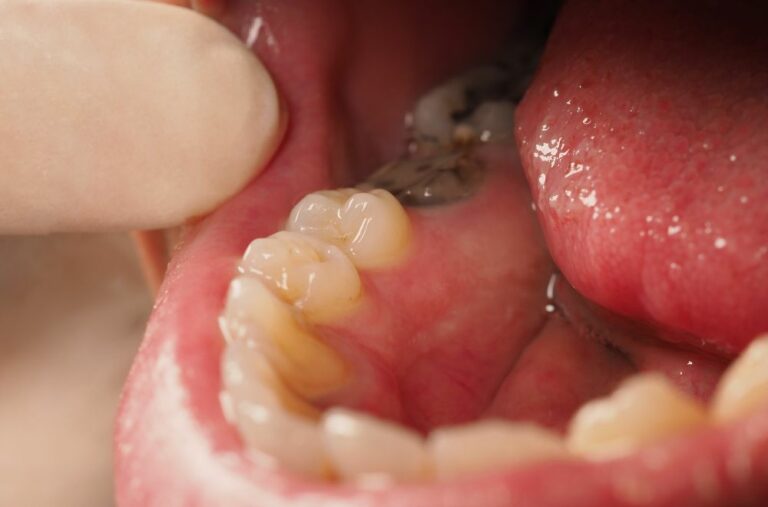 Why Your Teeth Are Decaying Despite Proper Care: Explained