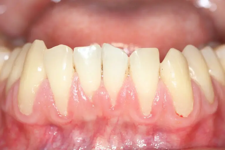 Why Are My Gums Receding And My Teeth Loose? (Causes & Treatments)