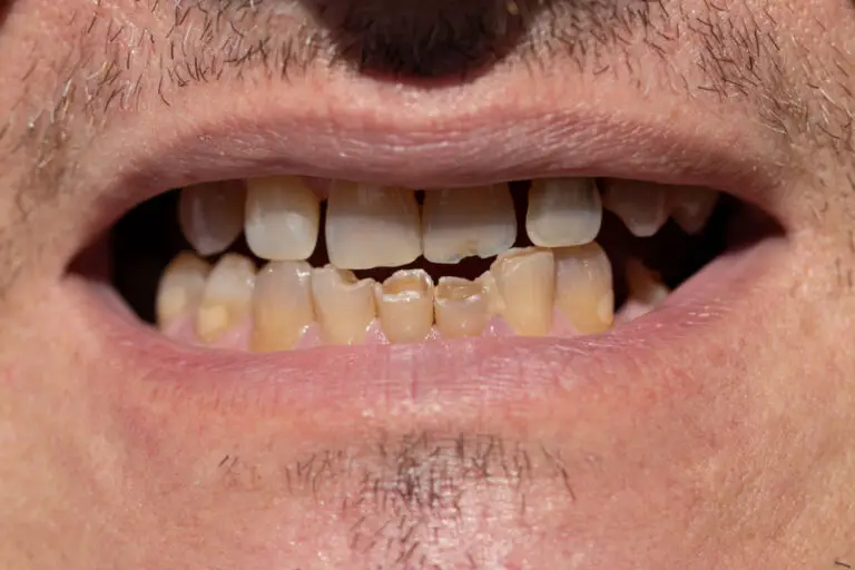 Why Are My Teeth Chipping So Easily? (How To Repair)