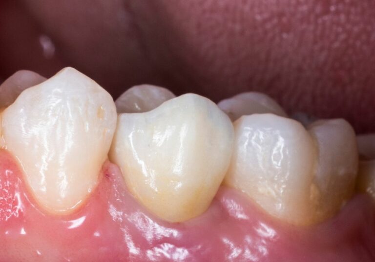 Why Are My Teeth Getting So Thin? (Tooth Enamel Loss)