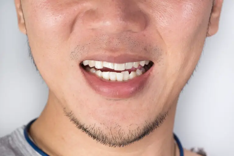 Why Are My Teeth So Weak And Keep Breaking? (Causes & Tips)