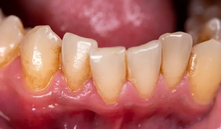 Why Are My Teeth Yellow at the Gum Line? Causes and Solutions