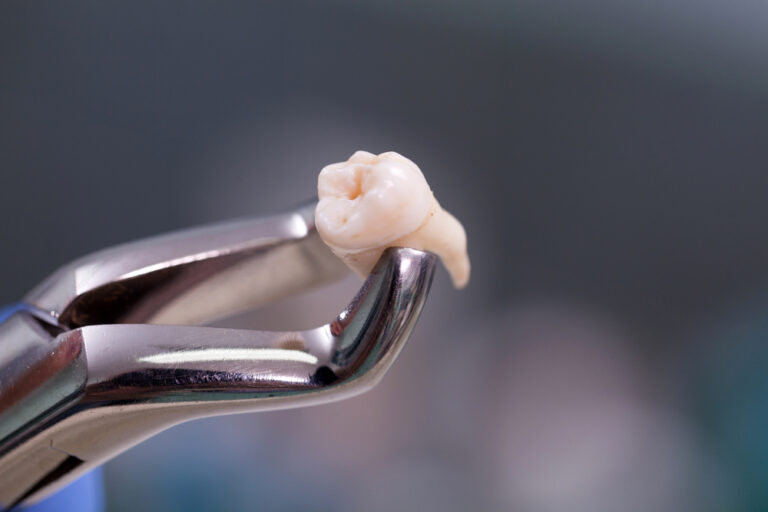 Why Can’t I Keep My Extracted Wisdom Teeth? (Reasons & Other Options)