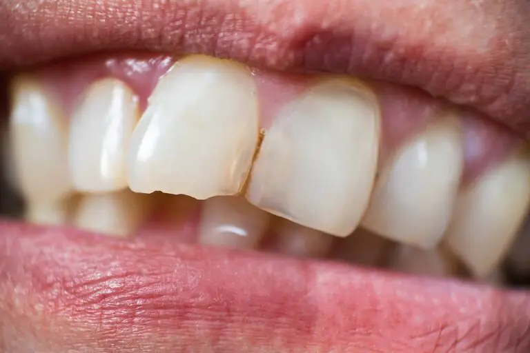Why Did A Piece Of My Tooth Break Off? (Causes & Treatment)