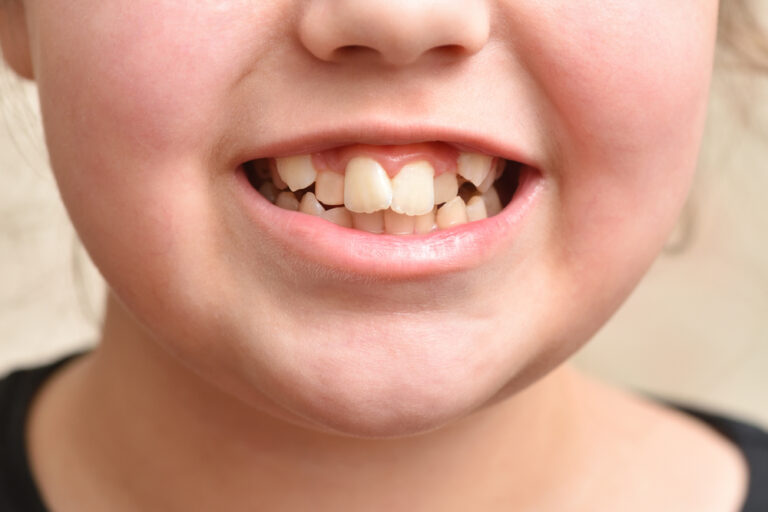 Why Did Humans Evolve Crooked Teeth? (Teeth Evolution Explained)