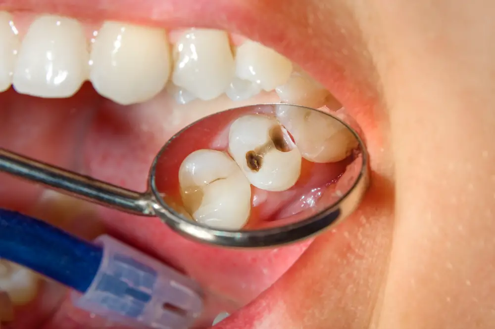 Why do I have cavities evev if I brush my teeth everyday? (Treatments