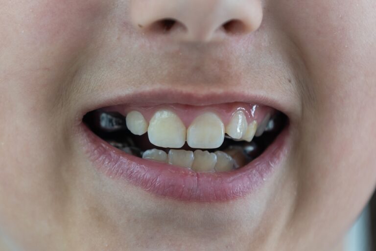 Why Do My Teeth Keep Moving Forward? (A Comprehensive Guide)