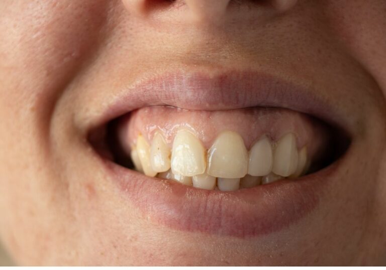 Why Do Old Teeth Turn Yellow? (Causes & Further Prevention)