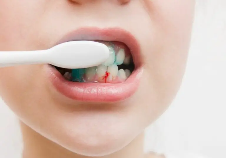 Why Do Teeth Bleed So Much? (Causes, Risks & Treatment)