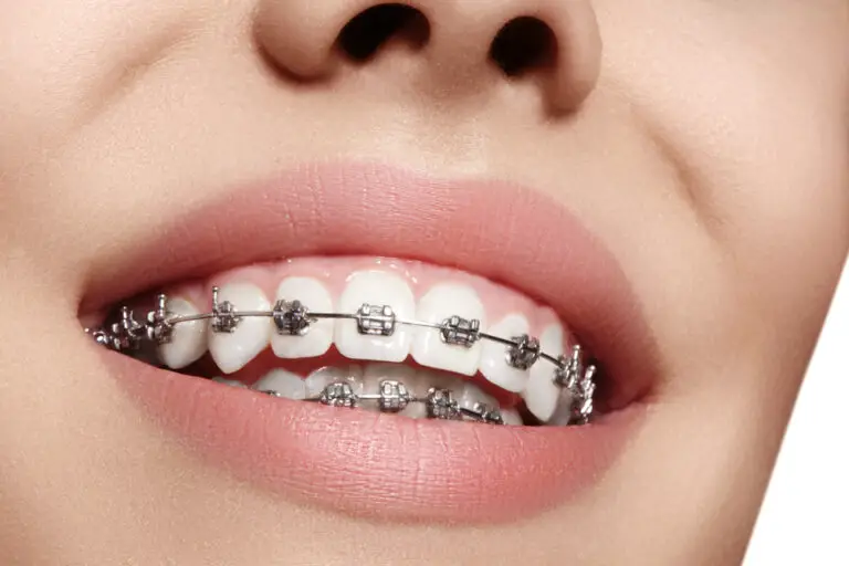 Why Do Teeth Get Yellow With Braces? (Reasons & Cleaning Tips)