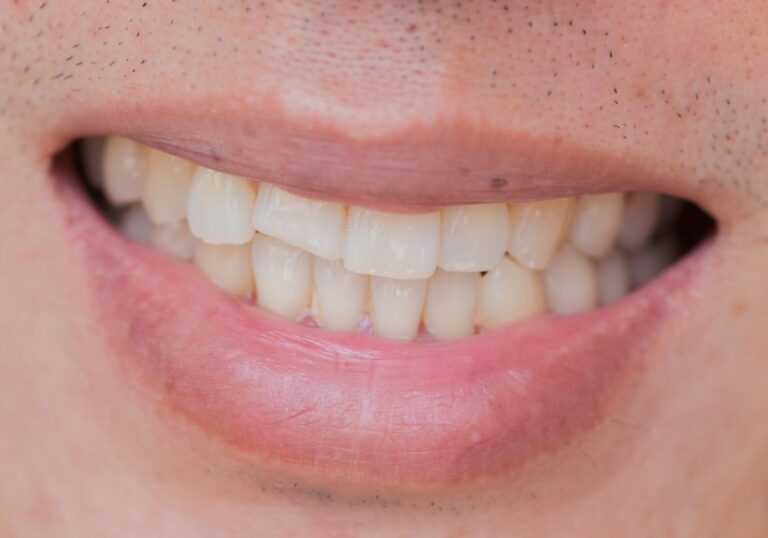 Why Do Teeth Not Repair? (Ultimate Guide)