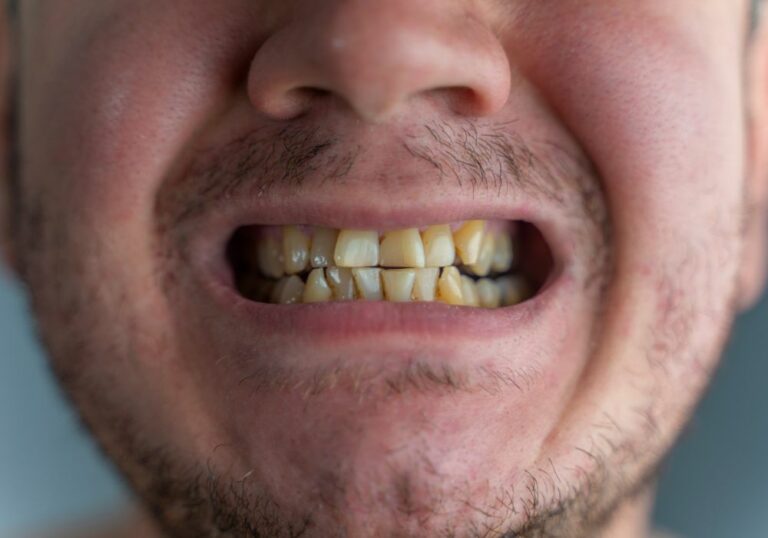 Why Does Beer Stain Teeth? (Find Out the Chemistry Behind)