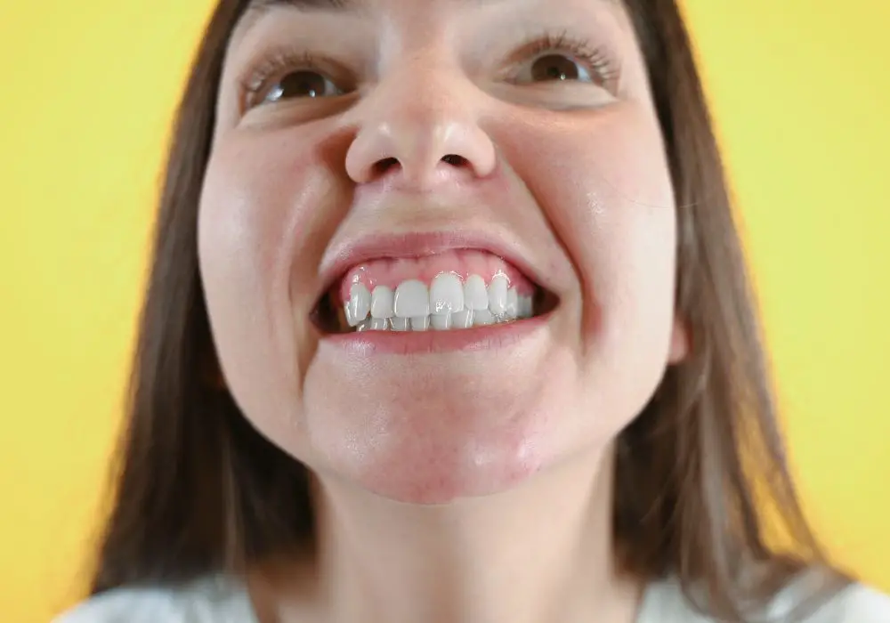 Why does gum recession matter?