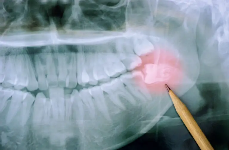 Why Keeping Your Wisdom Teeth Is Bad For You: Expert Insights