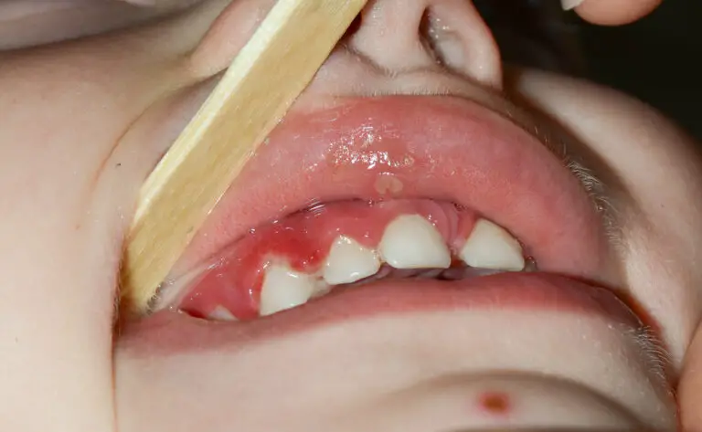 Why Is My 8 Year Old’s Gums Swollen? (Causes & Remedies)