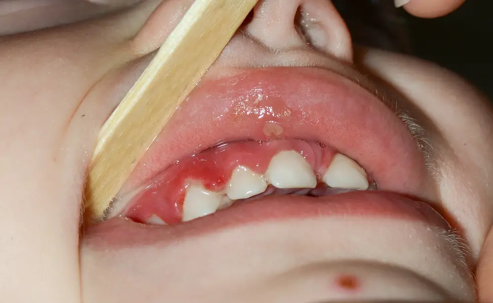 Why Is My 8 Year Old's Gums Swollen? (Causes & Remedies)