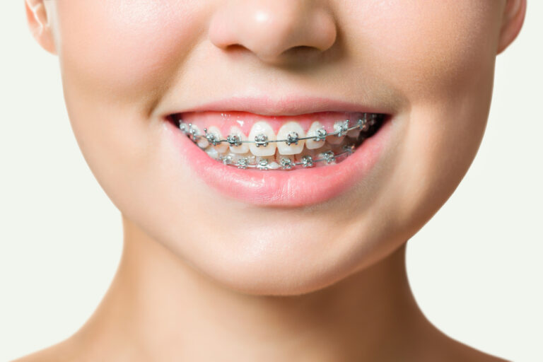 Why Is My Teeth Popping With Braces? (Causes & What To Do)