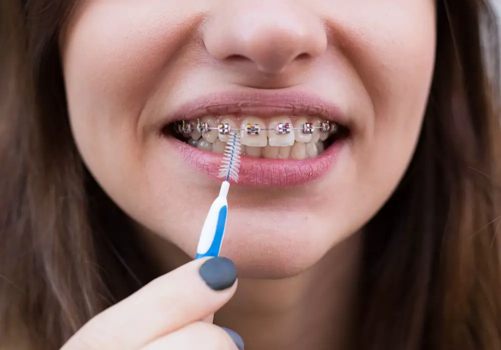 Why is my tooth gap getting bigger with braces? (Everything You Need To