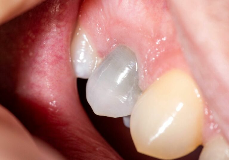 Will a Tooth Change Color After a Root Canal? Explained