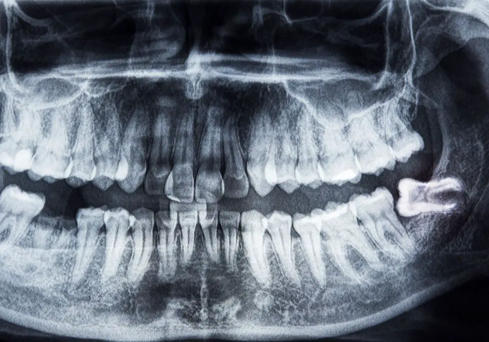 Wisdom tooth extraction