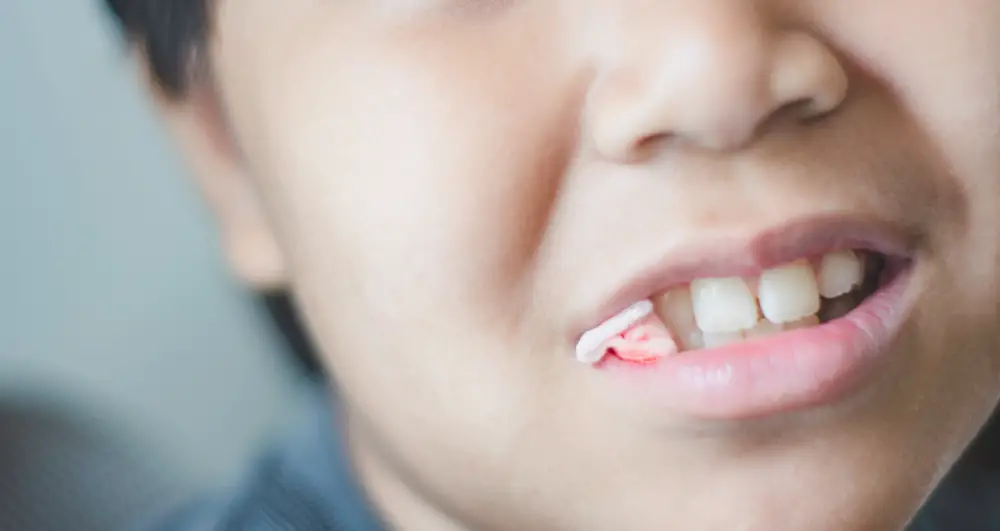 Can I Drink Water After Tooth Extraction with Gauze? Tips and Precautions