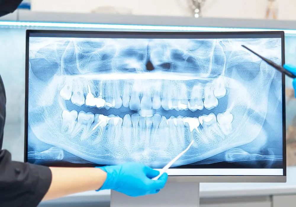 Application of Dental Radiographs in Age Estimation