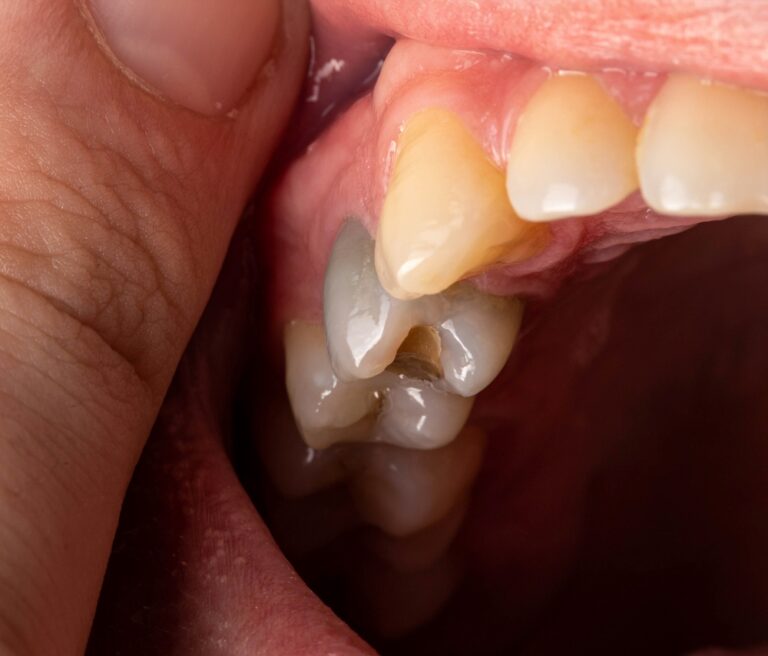 Are Black Teeth Serious? Causes and Treatment Options