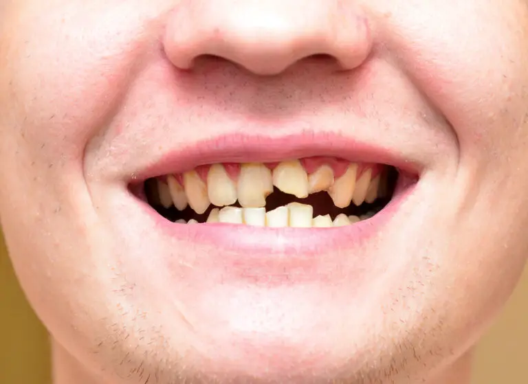 Are Broken Teeth Common? Causes, Treatment, and Prevention