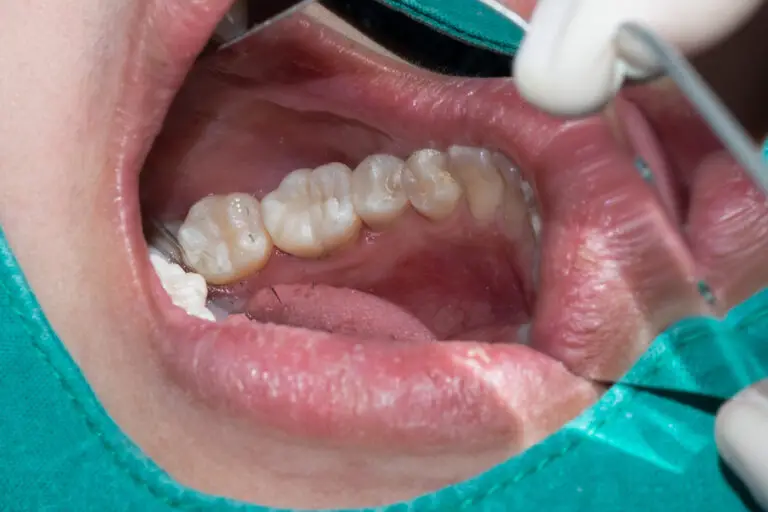 Are Composite Teeth Good? Pros and Cons Explained